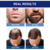 MINOXIDIL Topical Solution USP 5% Kirkland X12 Frascos (2 Cajas 720ml)