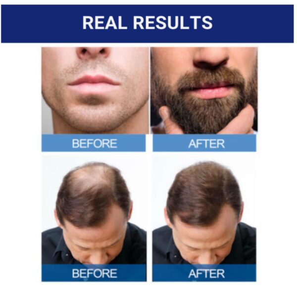 MINOXIDIL Topical Solution USP 5% Kirkland X12 Frascos (2 Cajas 720ml)